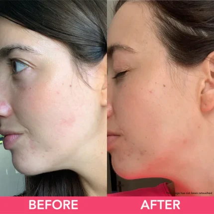 HYALURONIC INFUSION